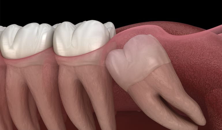Cirugía de terceros molares