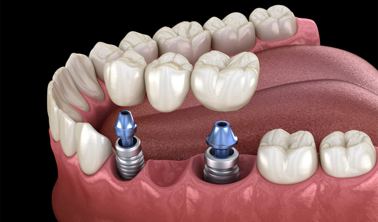 Prótesis Fija y Removible