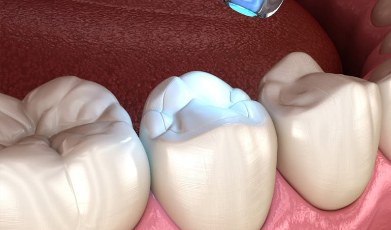 Resina Fotopolimerizable