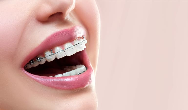 Tratamiento de Ortodoncia
